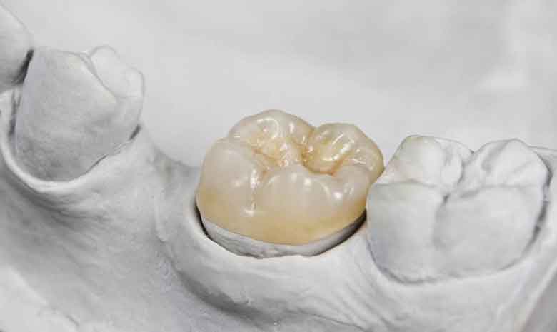 How Long Do Dental Crowns Last?